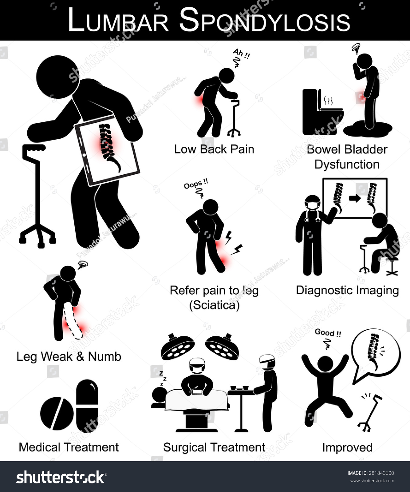 腰椎病症状的象形文字(腰痛,是指疼痛的腿,腿麻